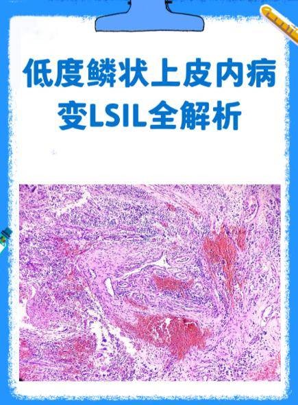 LSIL
