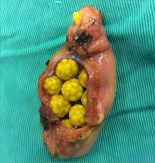 胆固醇结石
