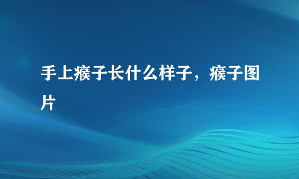 手上瘊子长什么样子，瘊子图片