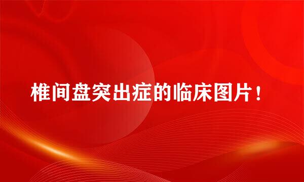 椎间盘突出症的临床图片！