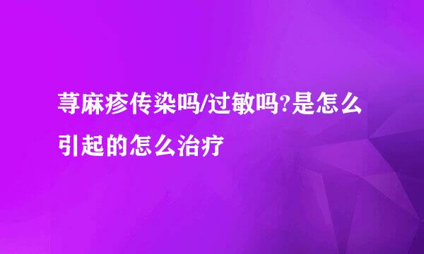 荨麻疹传染吗/过敏吗?是怎么引起的怎么治疗