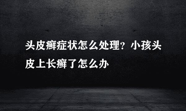 头皮癣症状怎么处理？小孩头皮上长癣了怎么办